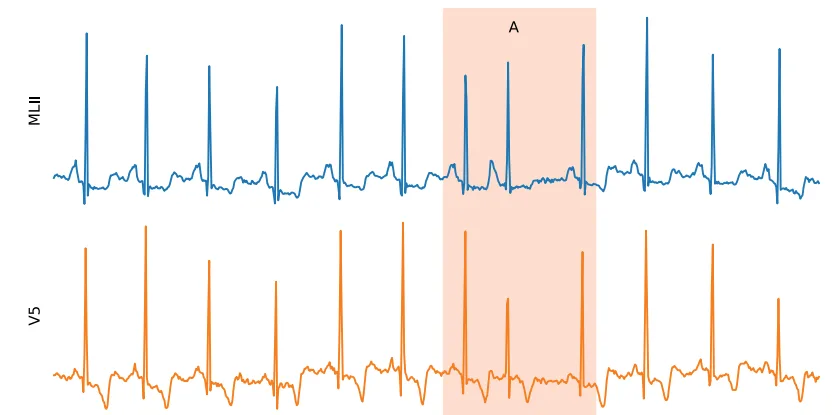 ECG anomaly example
